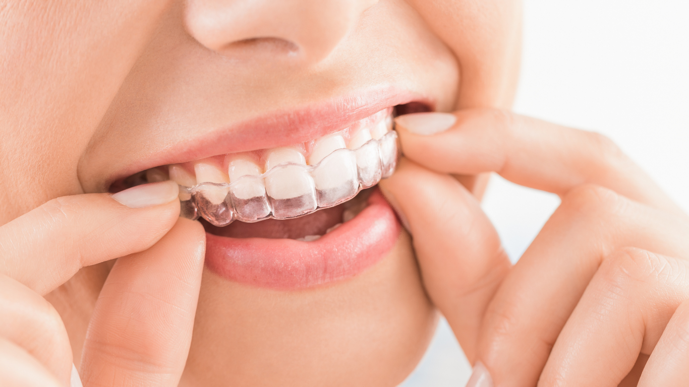 Vivera retainers after Invisalign treatment